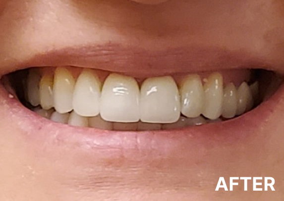 After dental implant restoration 